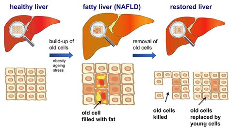 fatty liver you can reverse it Kindle Editon