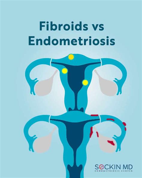 fibroid tumors and endometriosis Epub