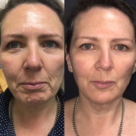 fillers for jowls