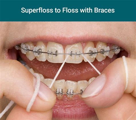 using floss threader to floss under braces wire step illustration