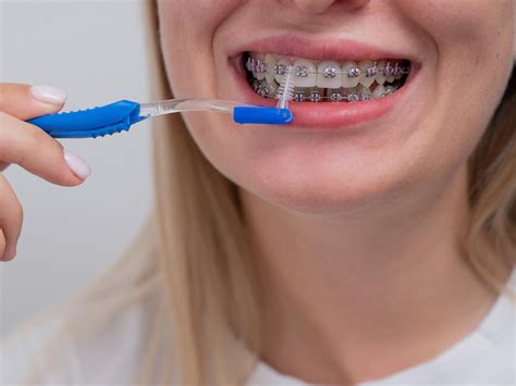 common flossing mistakes with braces teen Singapore