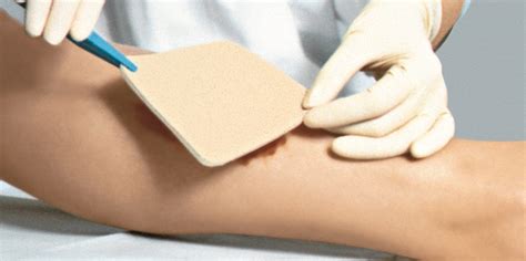 foam wound dressing