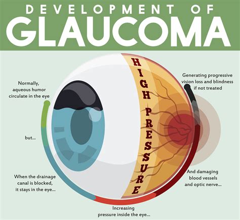 focus on glaucoma research focus on glaucoma research Epub