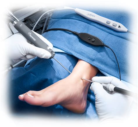 foot and ankle arthroscopy foot and ankle arthroscopy PDF
