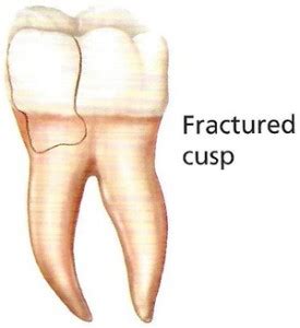 Fractured cusp on molar tooth showing missing enamel section