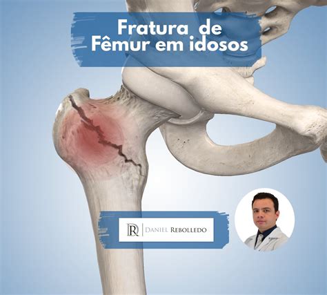 fratura de femur cid