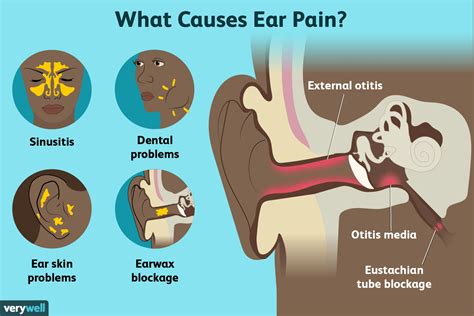 fullness in ear causes p h n after shingles Kindle Editon