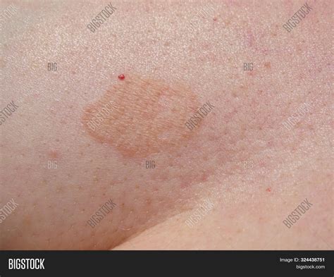 fungal dry patches on skin