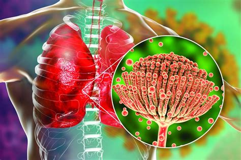 fungal infection in lungs