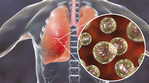 fungal infection of lungs