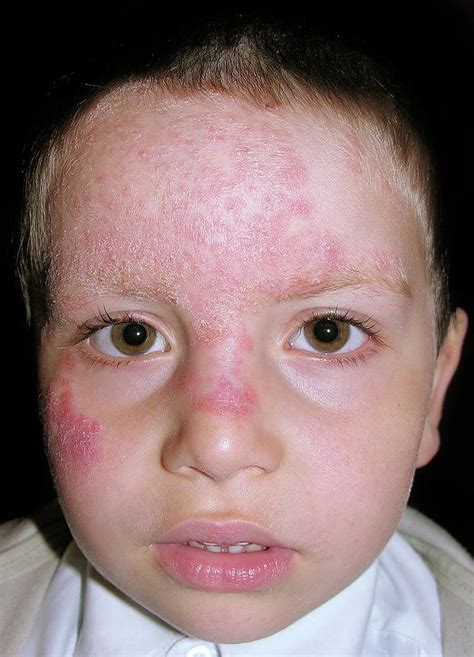 fungal infection on face