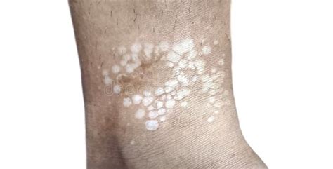 fungal skin infection causing white patches