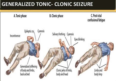 generalized tonic clonic seizure