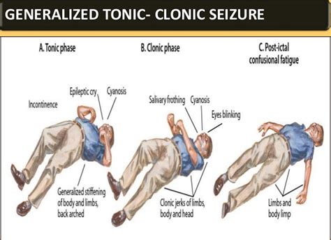 generalized tonic clonic seizure symptoms