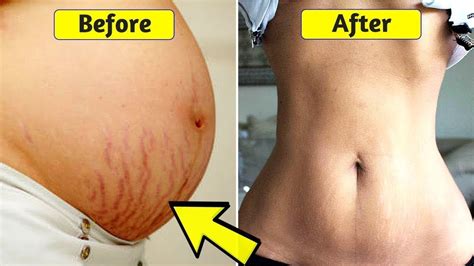 get rid of post pregnancy tummy