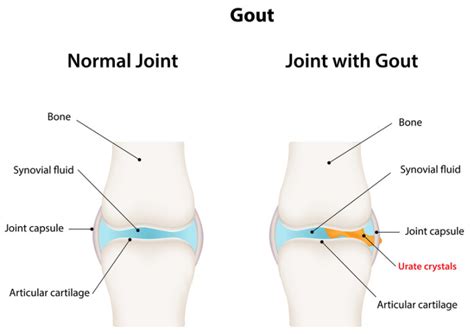 gout in knee how long does it last