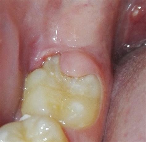 gums growing over teeth