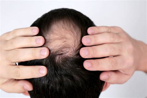 hair loss on top of head