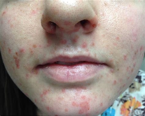 hand foot mouth disease on face