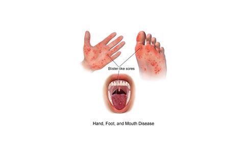 hand foot mouth disease sore throat