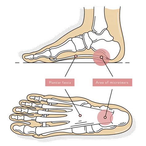 heel pain when standing for long periods