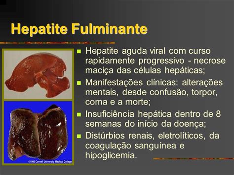 hepatite fulminante