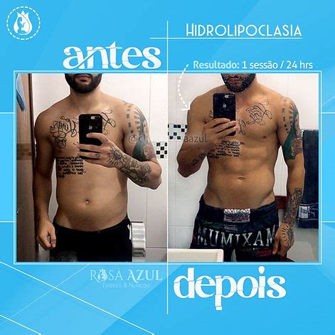 hidrolipoclasia antes e depois