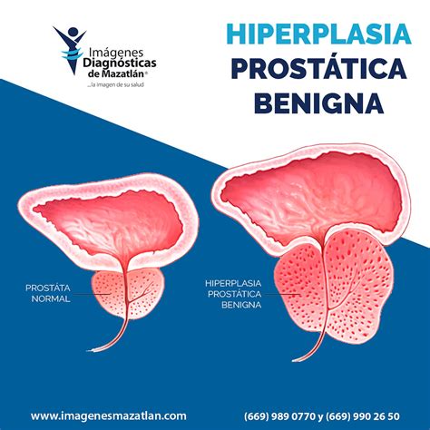 hiperplasia prostática benigna