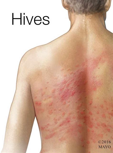 hives that come and go