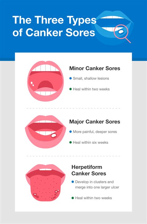 how long do canker sores take to heal