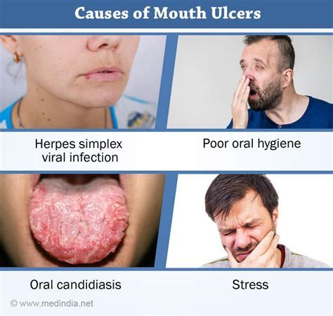 how long does a mouth ulcer take to heal