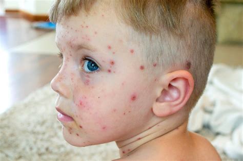 how long does chicken pox vaccine last