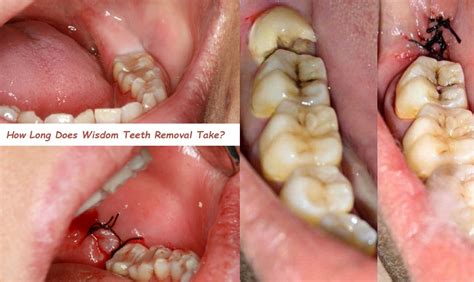 how long does it take wisdom teeth surgery to heal