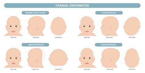 how long for newborn head to shape