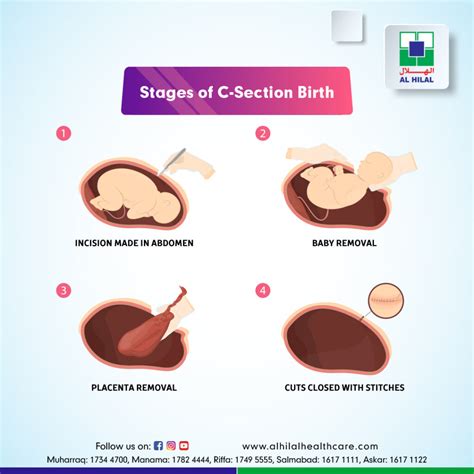 how many times cesarean delivery is safe