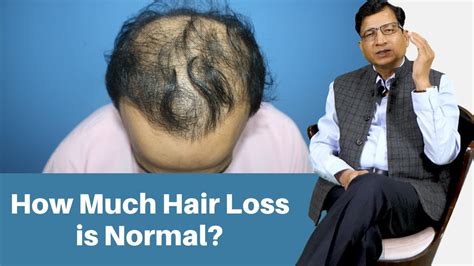 how much hair loss is normal