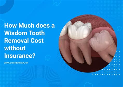 how much is wisdom teeth removal