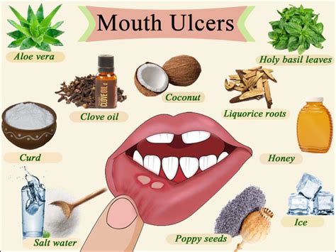 how to cure lip ulcers fast