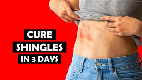 how to cure shingles in 3 days