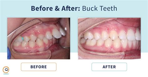 how to fix buck teeth after braces overview illustration