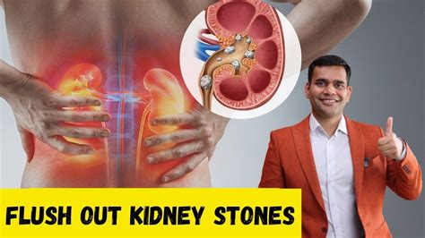 how to flush out kidney stones