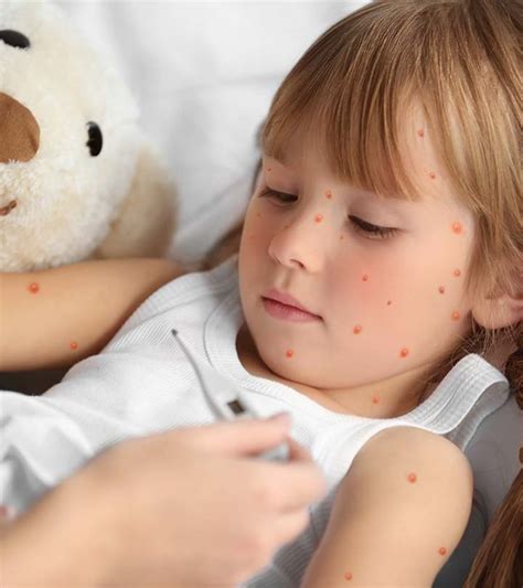 how to get rid of chickenpox