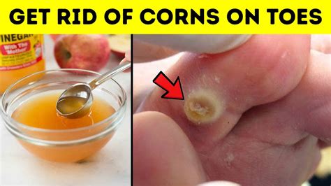 how to get rid of corn on foot