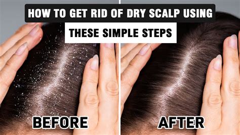 how to get rid of dry scalp