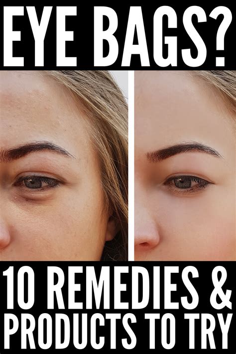 how to get rid of eye bags