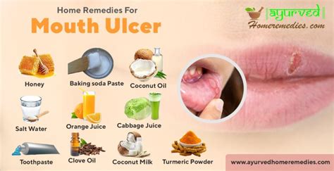 how to heal mouth ulcers fast