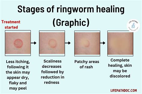 how to know if ringworm is healing