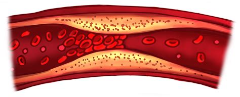 how to lower cholesterol without medication