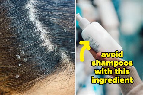 how to prevent dandruff and itchy scalp