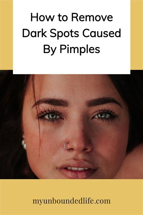 how to remove dark spots caused by pimples